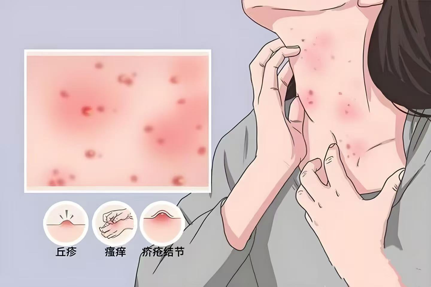 疥疮别害怕，带你认识它