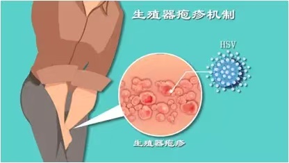 傻傻分不清的生殖器疱疹及其小伙伴